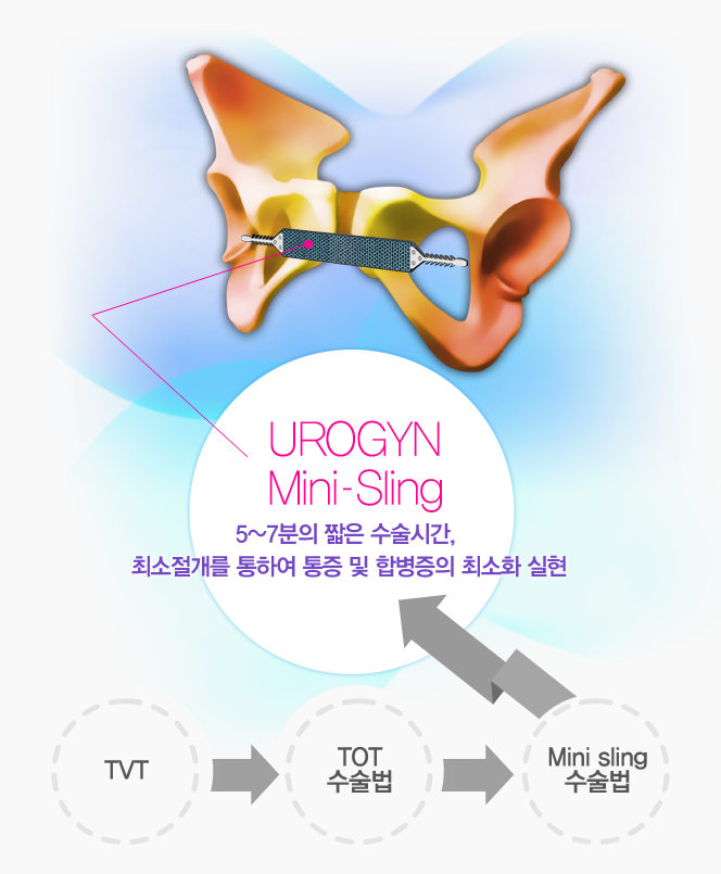 Urogyn Mini - SlingTVT-->TOT-->Mini sling5~7 ª ð, ּ Ͽ-> պ ּȭ