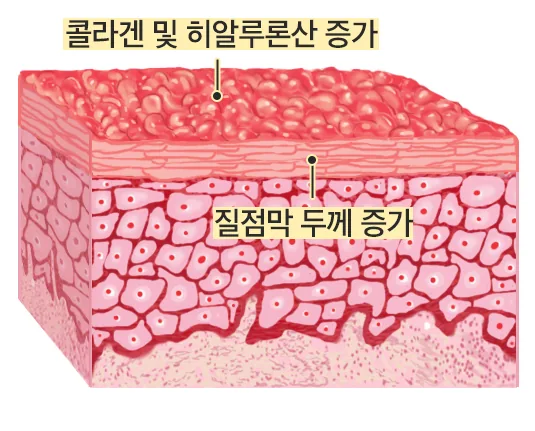 비너셀 시술 후
