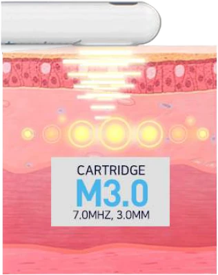 3.0mm 카트리지 도해