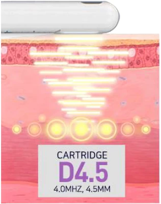 4.5mm 카트리지 도해