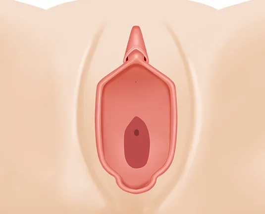 혈흔수술 후 - 깨끗하게 복원된 질막