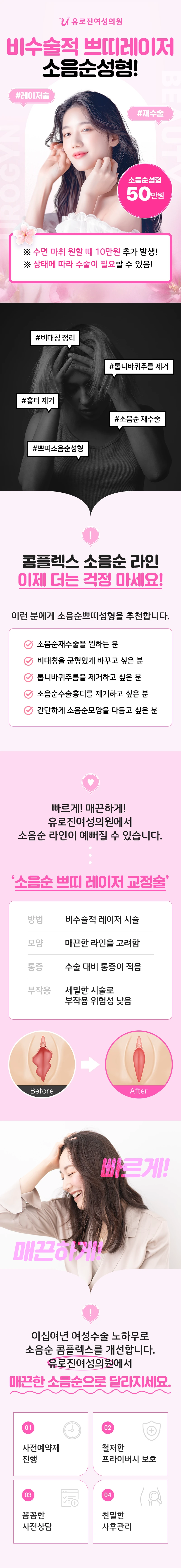 소음순 쁘띠 레이저 이벤트 - 소음순성형 50만원, 수면 마취 원할 때 10만원 추가. 추천 대상, 시술 방법·모양·통증·부작용 비교와 전후 안내