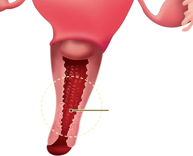 子宮と膣の断面図。膣の狭い部分を丸で示したもの