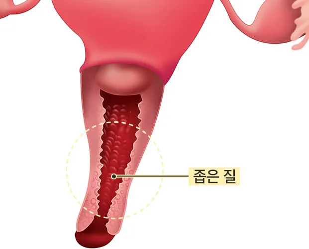 자궁과 질 단면 도해 - 좁은 질 부위를 원으로 표시