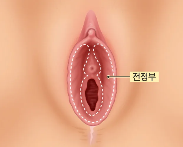 외음부 단면 도해 - 점선으로 표시한 전정부 위치