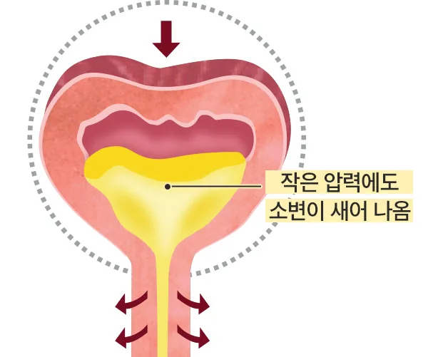 작은 압력에도 소변이 새어 나오는 방광 단면 도해