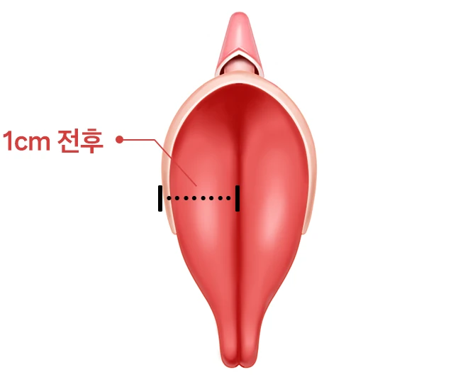 소음순의 좌우 폭을 표시한 도해