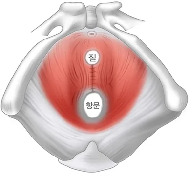 골반근육강화술 후 - 좁혀진 질근육