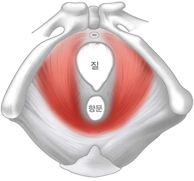 골반근육강화술 전 - 이완된 질근육