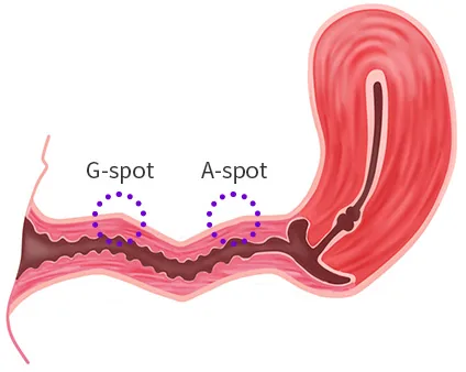 질축교정 후 - 굴곡진 질축. G-spot과 A-spot 위치 표시