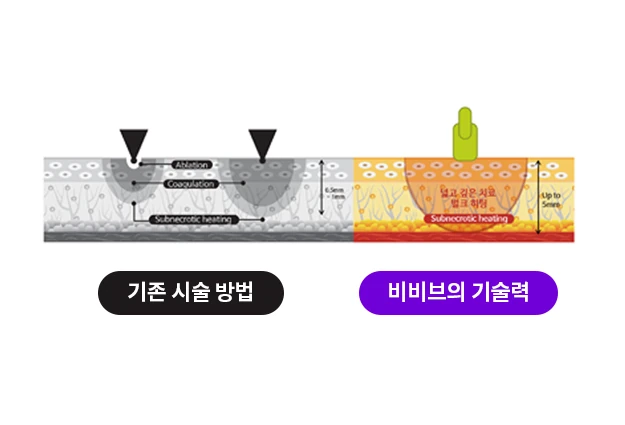 비비브가 질 조직 깊고 넓은 범위에 에너지를 전달하는 모습을 보여주는 도해