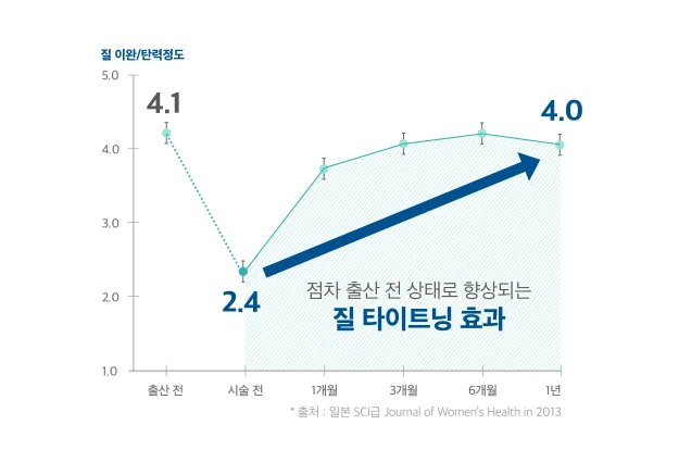비비브 시술 후 시간이 지날수록 탄력감이 올라가는 경과를 보여주는 도해